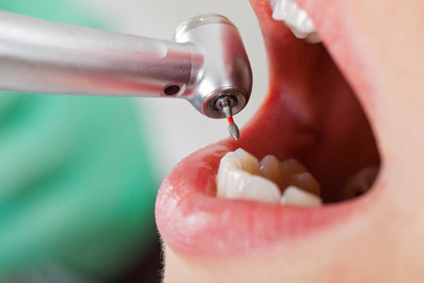 Best Root Canal Emergency Dentist  in Millersport, OH